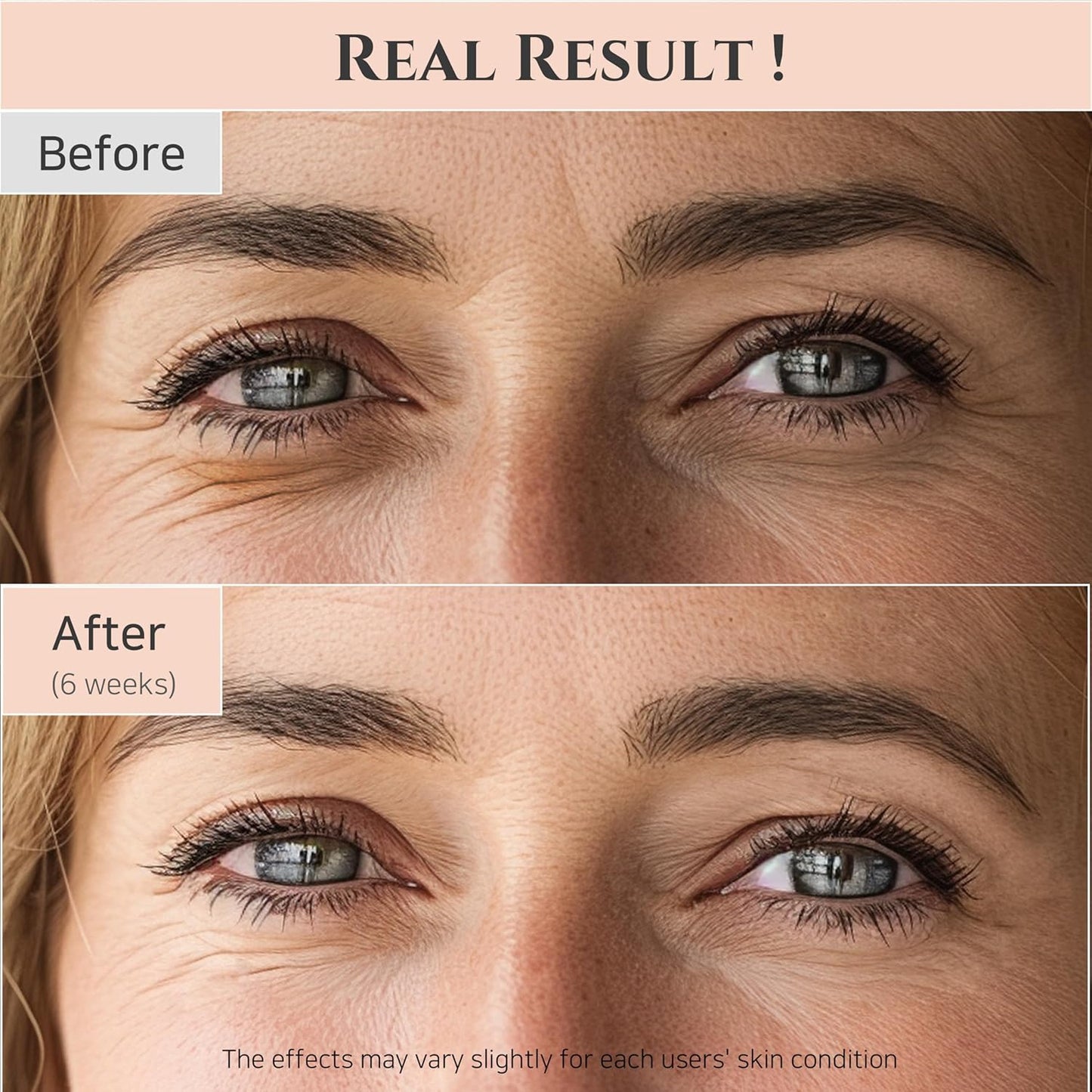 Before and after comparison of eye area treatment showing reduced wrinkles.