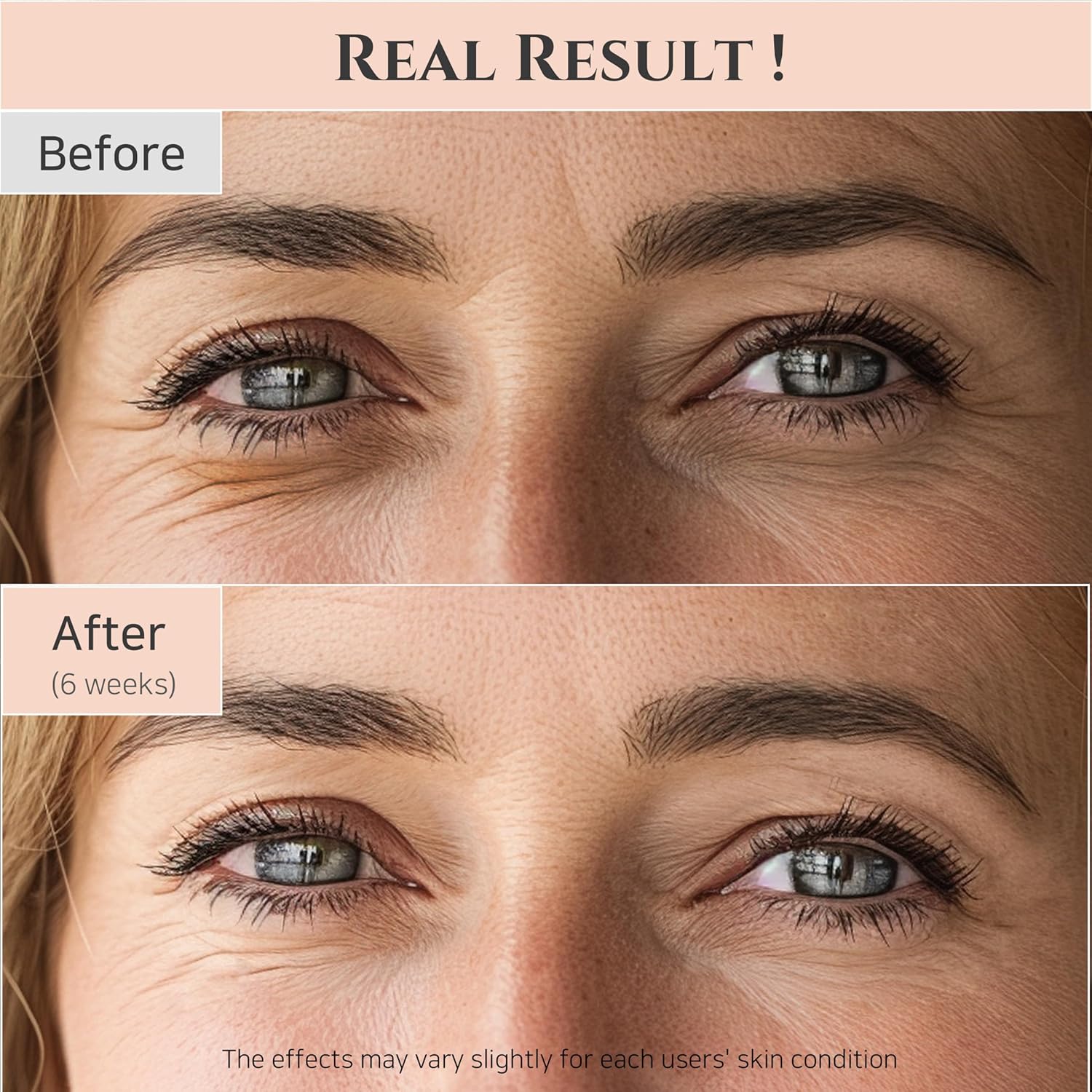Before and after comparison of eye area treatment showing reduced wrinkles.
